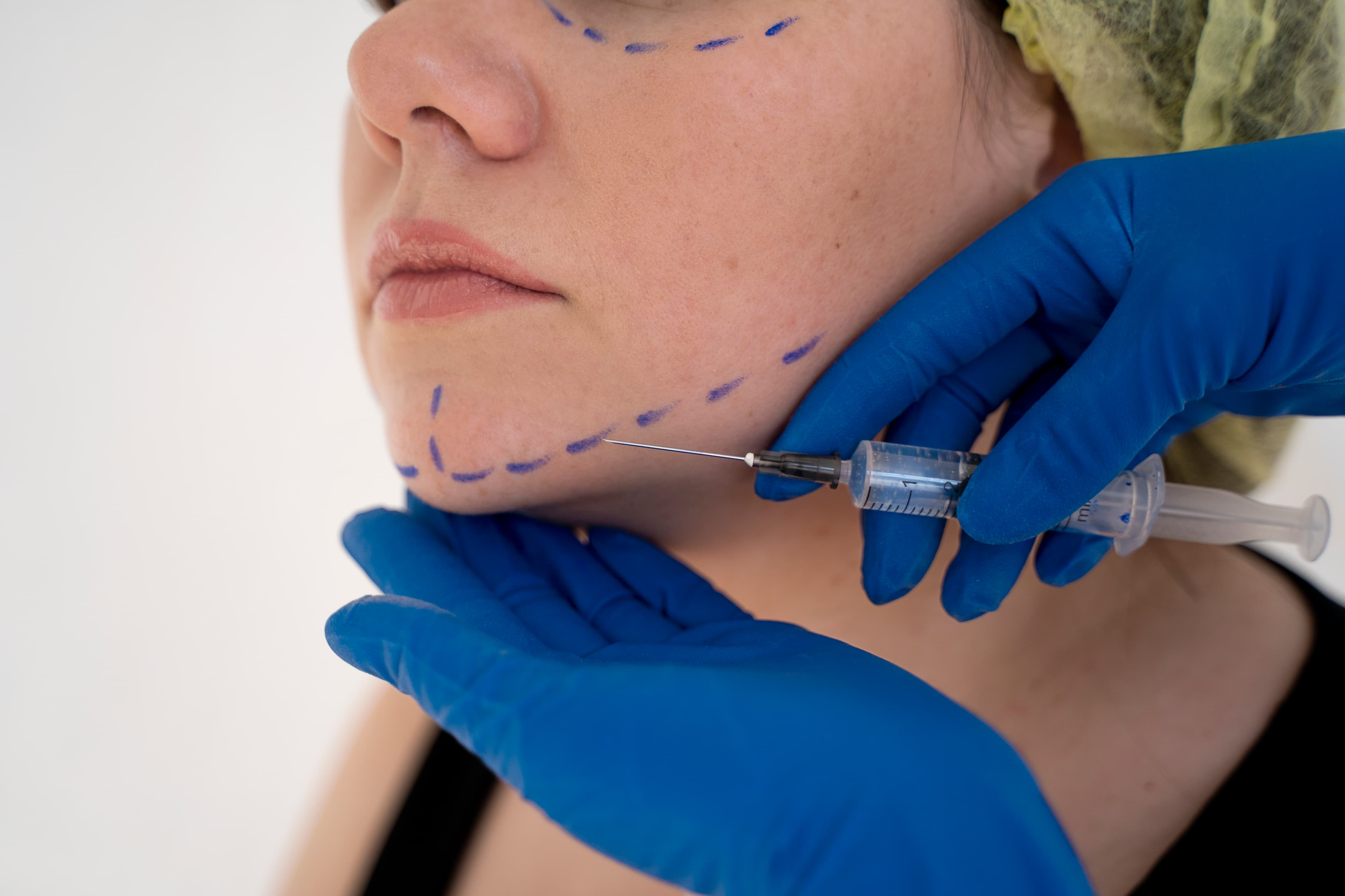 Armonización Facial